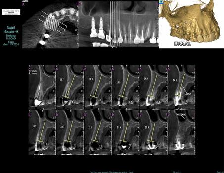 عکس CBCT دندان