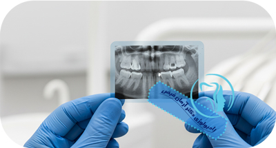 بهترین نوع رادیوگرافی برای ایمپلنت دندان