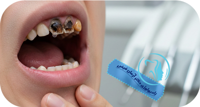 عفونت دندان در پانورکس | مرکز رادیولوژی دکتر آرمان فیض