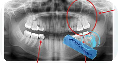 خطای تفسیر عکس دندان | کلینیک دکتر آرمان فیض
