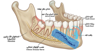 آیا دندان عقل نهفته همیشه نیاز به جراحی دارد؟ | نقش CBCT در تصمیم‌گیری دقیق